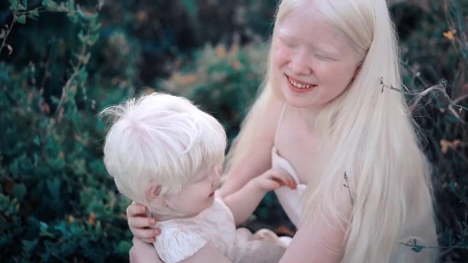 albinos3